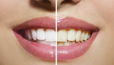 Відбілювання зубів. Фото до після